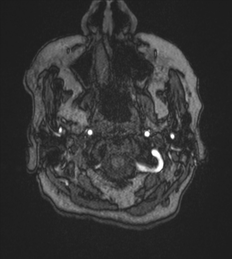 Atypical meningioma (WHO Grade II) (Radiopaedia 54742-60981 Axial MRA 2).png