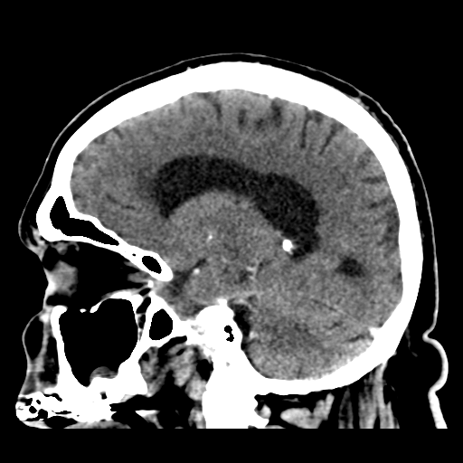 Atypical meningioma (WHO grade II) with brain invasion (Radiopaedia 57767-64728 Sagittal C+ 33).png