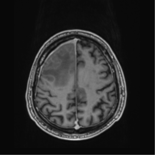 File:Atypical meningioma (WHO grade II) with brain invasion (Radiopaedia 57767-64729 Axial T1 C+ 37).png