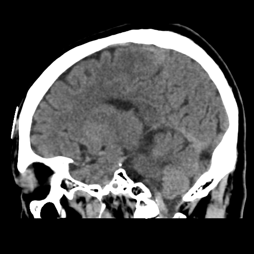 Atypical meningioma (WHO grade II) with osseous invasion (Radiopaedia 53654-59715 C 33).png