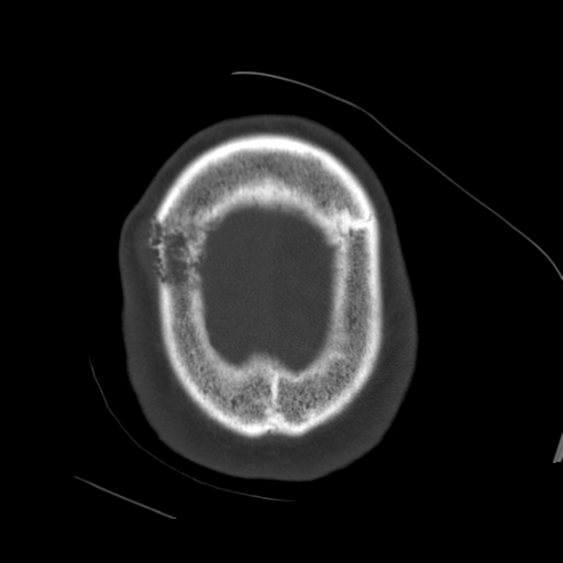 File:Atypical meningioma with skull invasion (Radiopaedia 34357-35649 Axial bone window 73).png