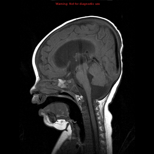 File:Atypical teratoid rhabdoid tumor (Radiopaedia 10712-11183 Sagittal T1 10).jpg