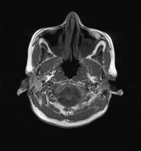 File:Autoimmune limbic encephalitis (Radiopaedia 30363-31005 Axial T1 3).jpg