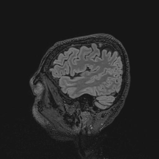 Autoimmune limbic encephalitis (Radiopaedia 30363-31005 Sagittal FLAIR 125).jpg