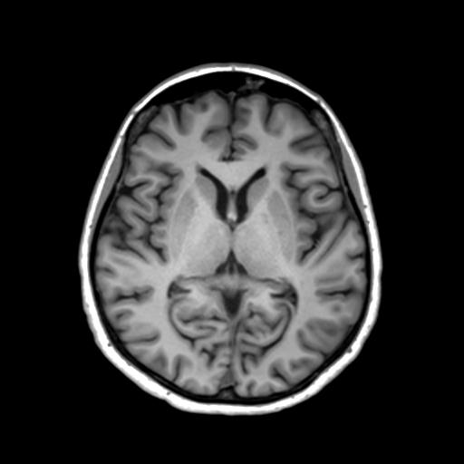 Autoimmune limbic encephalitis (Radiopaedia 30363-31005 T1 Axial 3mm 27).jpg