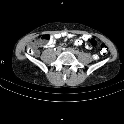File:Autoimmune pancreatitis (Radiopaedia 84925-100431 Axial C+ delayed 57).jpg