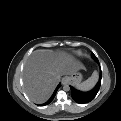 Autosomal dominant polycystic kidney disease (Radiopaedia 50259-55612 Axial non-contrast 16).jpg
