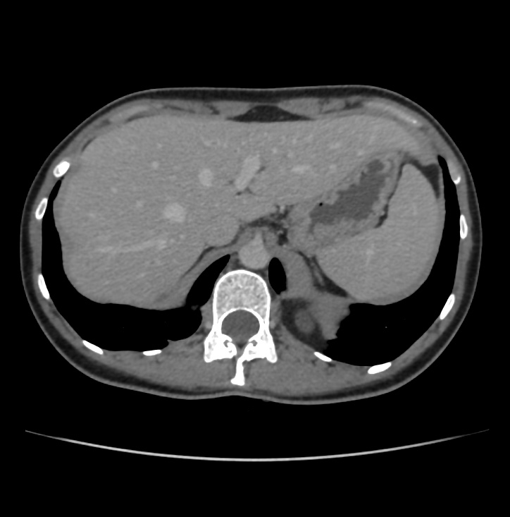 Autosomal dominant polycystic kidney disease - early onset (Radiopaedia 40734-43387 A 5).jpg