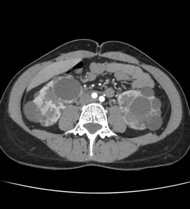 Autosomal dominant polycystic kidney disease - early onset (Radiopaedia 40734-43387 B 41).jpg