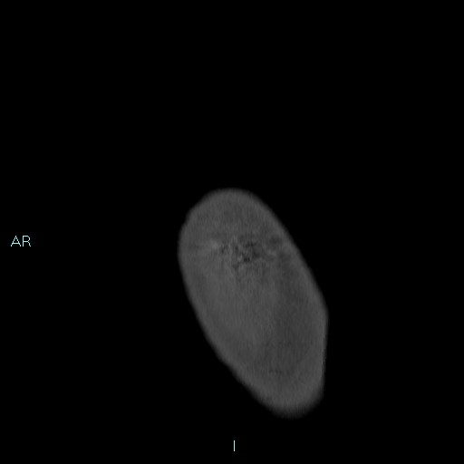 File:Avascular necrosis after fracture dislocations of the proximal humerus (Radiopaedia 88078-104653 Sagittal bone window 6).jpg