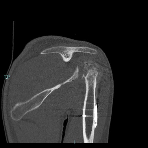 Avascular necrosis after fracture dislocations of the proximal humerus (Radiopaedia 88078-104655 Coronal bone window 62).jpg