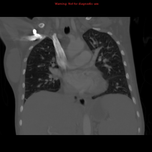 File:Avascular necrosis in sickle cell disease (Radiopaedia 17448-17152 Coronal bone window 62).jpg