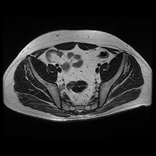 File:Avascular necrosis of the hip (Radiopaedia 61503-69465 T2 7).jpg