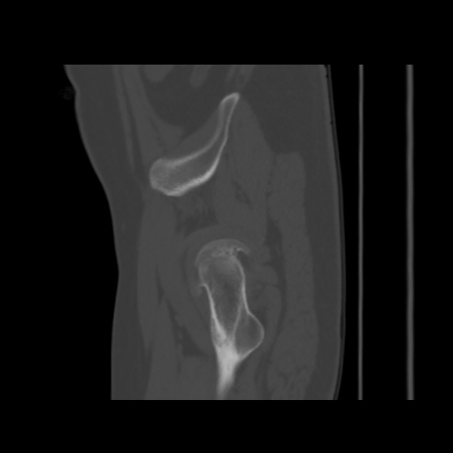 Avascular necrosis of the hip (Radiopaedia 61503-69467 B 52).jpg