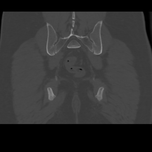 File:Avascular necrosis of the hip (Radiopaedia 61503-69467 Coronal bone window 34).jpg