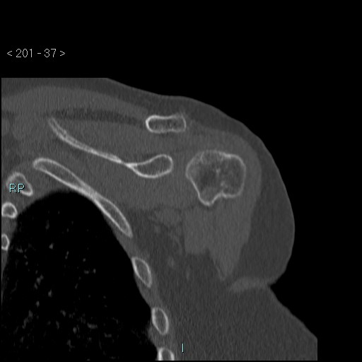 Avascular necrosis of the shoulder - Cruess stage I (Radiopaedia 77674-89887 Coronal bone window 36).jpg