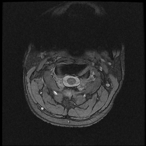 File:Axis fracture - MRI (Radiopaedia 71925-82375 Axial T2 fat sat 1).jpg