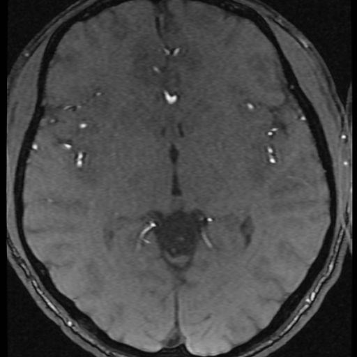 File:Azygos anterior cerebral artery (Radiopaedia 17059-16756 Axial MRA 20).jpg