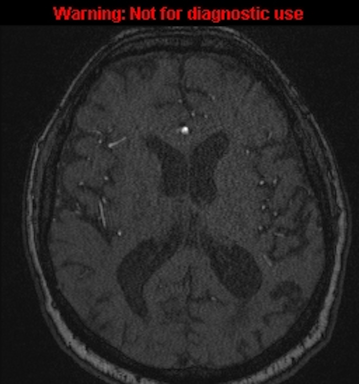 Azygos anterior cerebral artery (Radiopaedia 59325-66677 Axial MRA 100).jpg