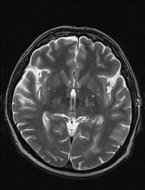 File:Balo concentric sclerosis (Radiopaedia 50458-55940 Axial T2 24).jpg