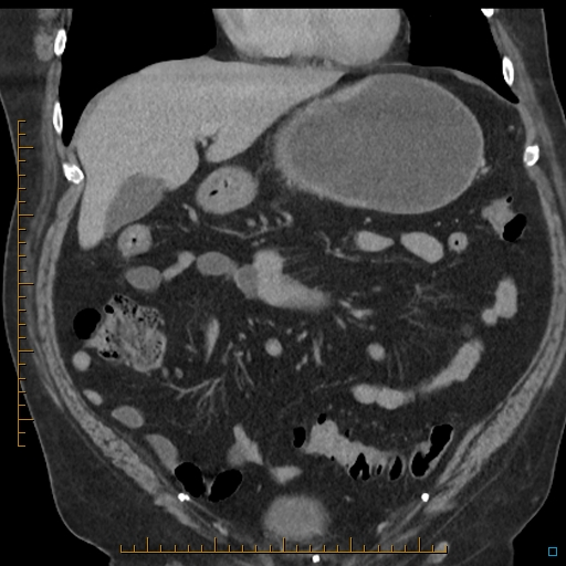 File:Bariatric balloon causing gastric outlet obstruction (Radiopaedia 54449-60672 B 21).jpg