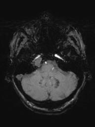 Base of skull chondrosarcoma (Radiopaedia 30410-31070 Axial SWI 13).jpg