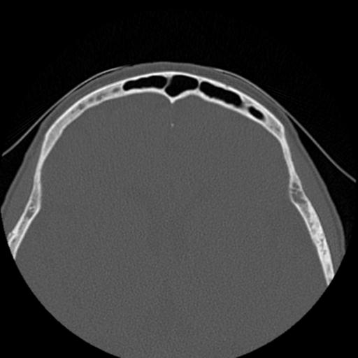 File:Base of skull chondrosarcoma (Radiopaedia 30410-31071 Axial bone window 41).jpg