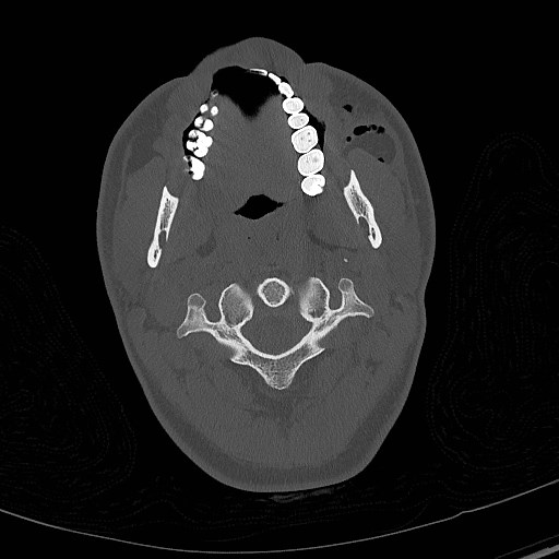 File:Base of skull fracture with bilateral Le Fort fractures (Radiopaedia 47094-51638 Axial bone window 9).jpg