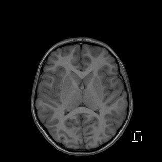 File:Base of skull rhabdomyosarcoma (Radiopaedia 32196-33142 Axial T1 29).jpg
