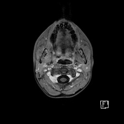 Base of skull rhabdomyosarcoma (Radiopaedia 32196-33142 T1 C+ fat sat 15).jpg