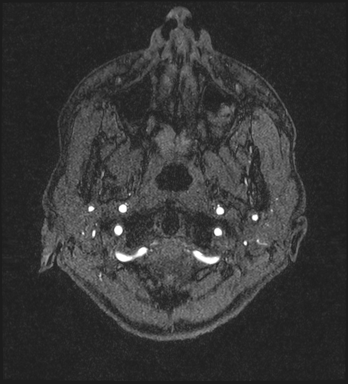 Basilar artery perforator aneurysm (Radiopaedia 82455-97733 Axial MRA 2).jpg