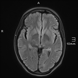 File:Basilar artery perforator aneurysm (Radiopaedia 82455-99523 Axial FLAIR 11).jpg