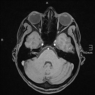 Basilar artery perforator aneurysm (Radiopaedia 82455-99523 F 33).jpg