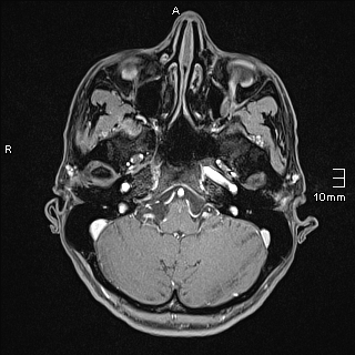 File:Basilar artery perforator aneurysm (Radiopaedia 82455-99523 G 19).jpg