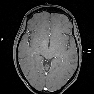 File:Basilar artery perforator aneurysm (Radiopaedia 82455-99523 G 70).jpg