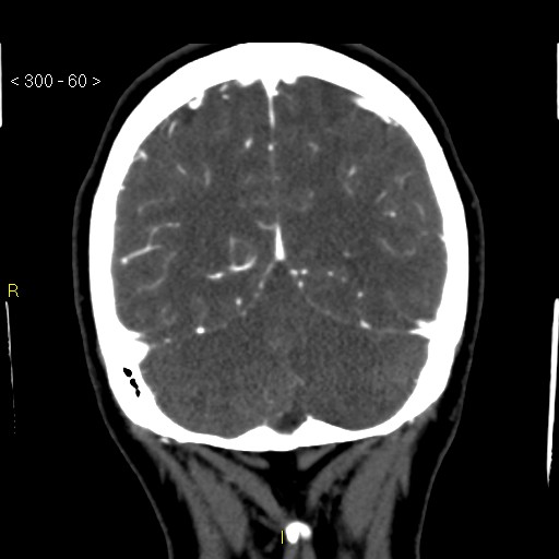 File:Basilar artery thrombosis (Radiopaedia 16260-15944 B 51).jpg