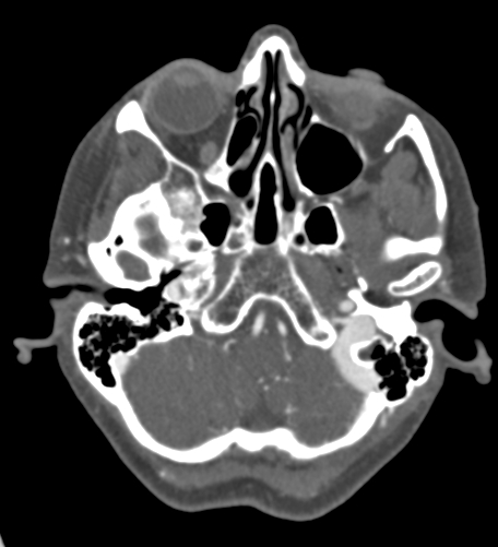 Basilar tip aneurysm with coiling (Radiopaedia 53912-60086 A 29).jpg