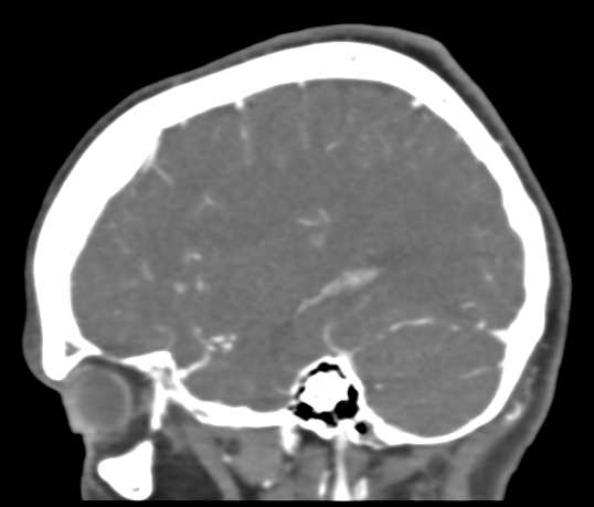 Basilar tip aneurysm with coiling (Radiopaedia 53912-60086 C 100).jpg