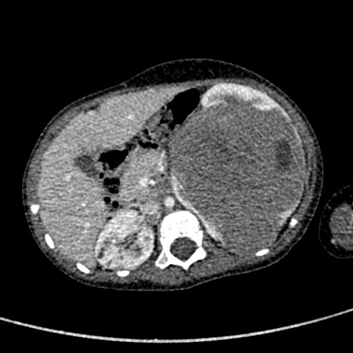 Beckwith-Wiedeman syndrome with bilateral Wilms tumors (Radiopaedia 60850-68629 A 57).jpg