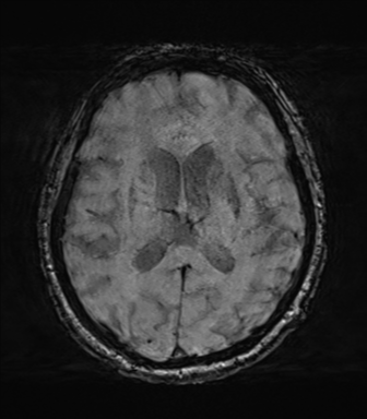 Behavioral variant frontotemporal dementia and late onset schizophrenia (Radiopaedia 52197-58083 Axial SWI 42).png