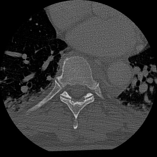 Benign post-traumatic pseudopneumoperitoneum (Radiopaedia 71199-81495 Axial bone window 112).jpg