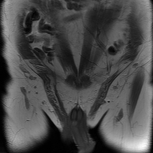 File:Benign prostatic nodular hyperplasia (Radiopaedia 16917-16634 Coronal T1 1).jpg