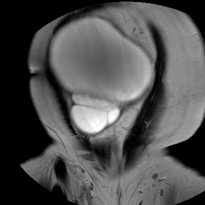 File:Benign seromucinous cystadenoma of the ovary (Radiopaedia 71065-81300 F 5).jpg