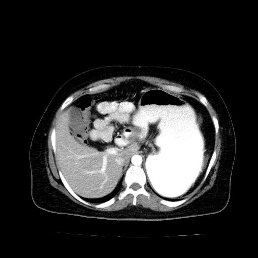 File:Benign spindle cell tumor - abdominopelvic (Radiopaedia 61300-69212 A 14).jpg