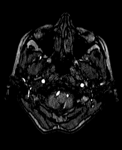 Berry aneurysm of the terminal internal carotid artery (Radiopaedia 88286-104918 Axial TOF 44).jpg