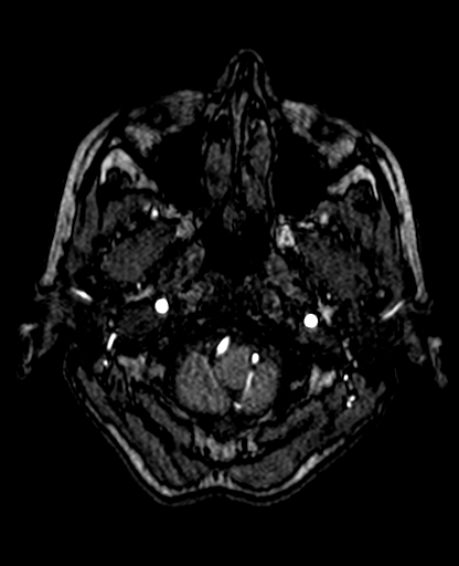 Berry aneurysm of the terminal internal carotid artery (Radiopaedia 88286-104918 Axial TOF 46).jpg