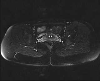 File:Bicornuate bicollis uterus (Radiopaedia 61626-69616 Axial PD fat sat 23).jpg