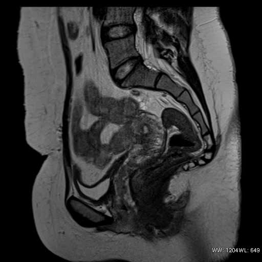 File:Bicornuate uterus- on MRI (Radiopaedia 49206-54297 Sagittal T2 12).jpg