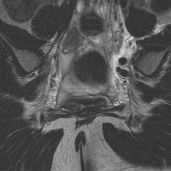 File:Bicornuate uterus (Radiopaedia 24677-24949 Coronal T2 15).jpg