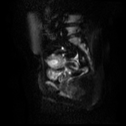 File:Bicornuate uterus (Radiopaedia 51676-57472 Sagittal DWI 16).jpg